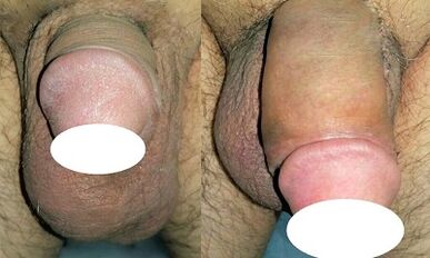 Foto antes y después de aumentar el pene